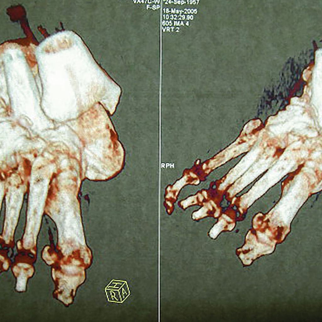 Der CharcotFuß als Sonderform des diabetischen Fußsyndroms Orthopädie & Traumatologie